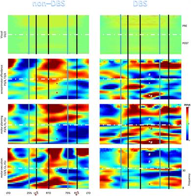 A Case-Controlled Pilot Study on Rhythmic Auditory Stimulation-Assisted Gait Training and Conventional Physiotherapy in Patients With Parkinson's Disease Submitted to Deep Brain Stimulation